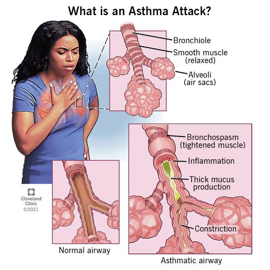 Asthma symptoms with vissible airway xonstrictiin