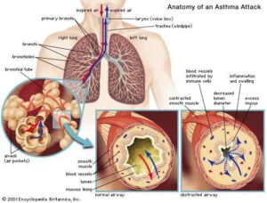 Chronic Bronchitis causes and inflammation of the airways