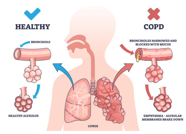 Chronic Obstructive Pulmonary disease (COPD) causes showing airway narrowing and mucus buildup