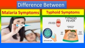Malaria-Typhoid difference shown in image